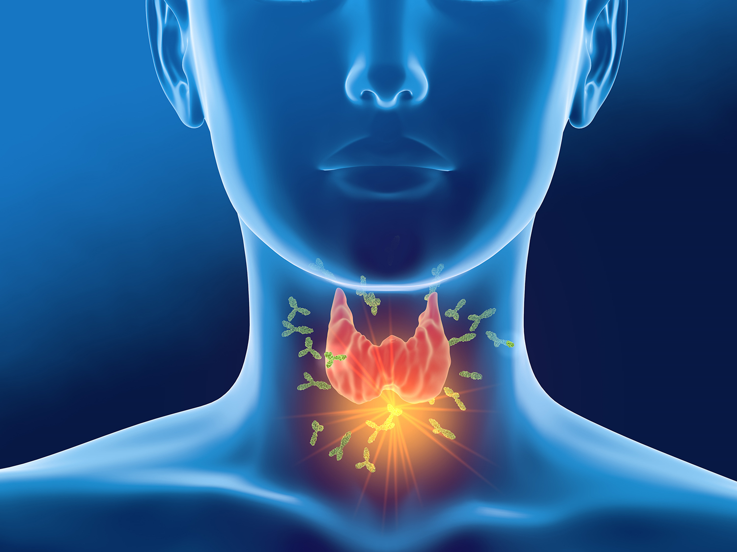 Medically 3D illustration showing antibodies attacking thyroid gland of a woman.
